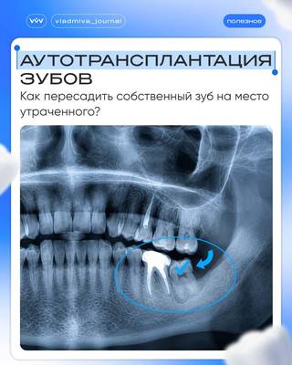 Аутотрансплантация зуба: 3D-модель и сохранение периодонтальной связки.